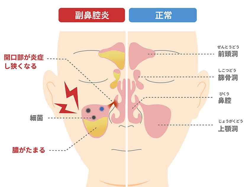 副鼻腔炎による頭痛