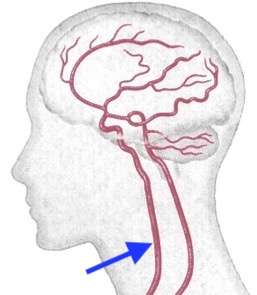 片頭痛の対処法