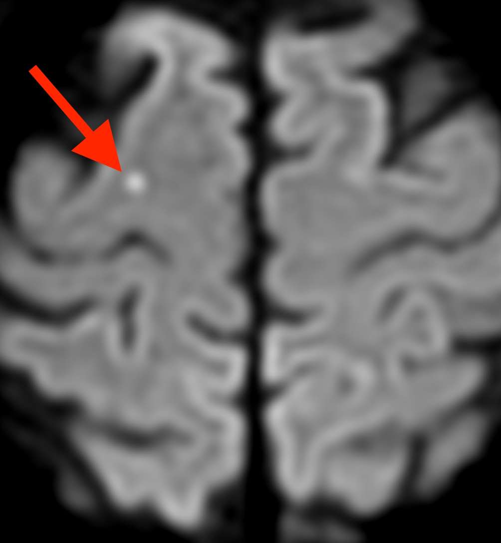 片頭痛と脳梗塞