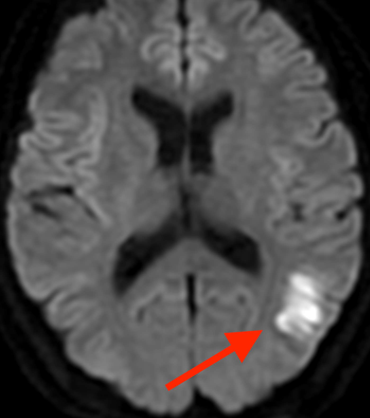 片頭痛と脳梗塞