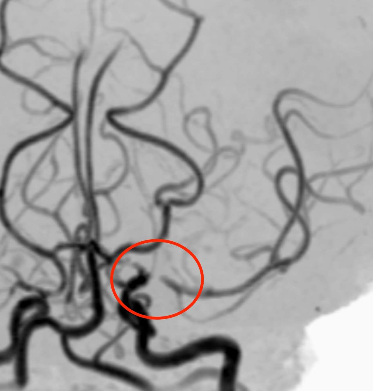 片頭痛と脳梗塞