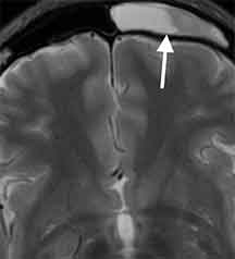 副鼻腔炎による頭痛