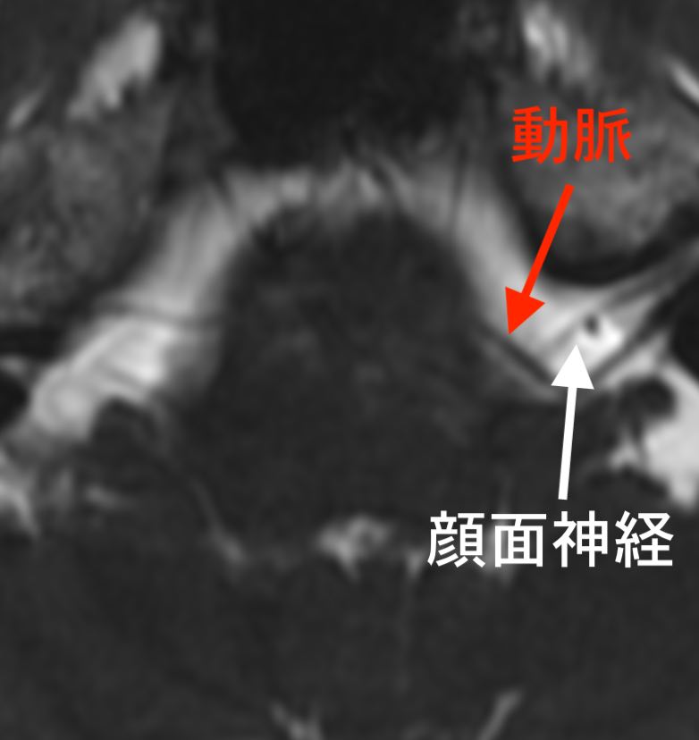 まぶたのけいれん