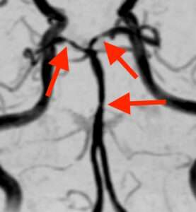 トイレでいきむと頭痛