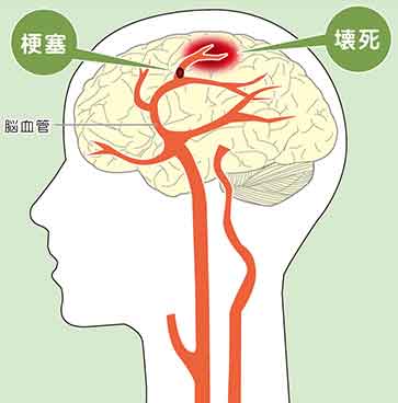 脳血管障害（脳卒中）