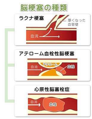 脳血管障害（脳卒中）