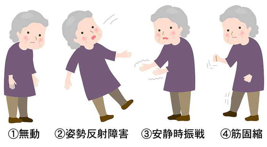 パーキンソン病の症状