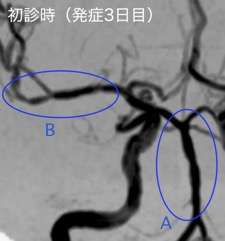 入浴やシャワーで頭痛
