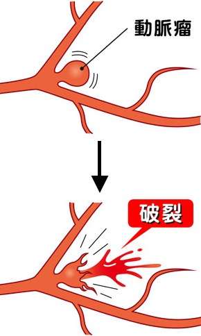 脳動脈瘤破裂