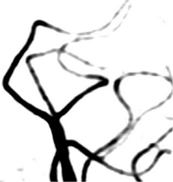 副鼻腔炎による可逆性脳血管攣縮症候群