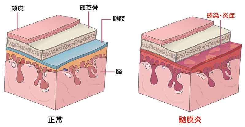 風邪後に頭痛だけが治らない