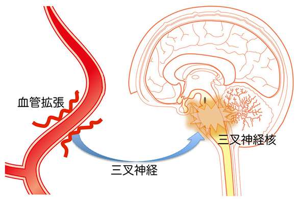 片頭痛の原因としくみ