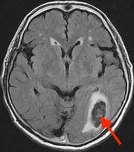 閃輝暗点の原因と頭痛がない場合